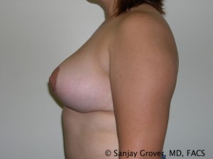 Breast Lift Before and After 19 | Sanjay Grover MD FACS