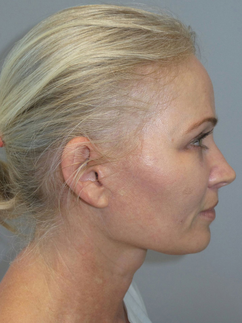 Facelift Before and After 08 | Sanjay Grover MD FACS