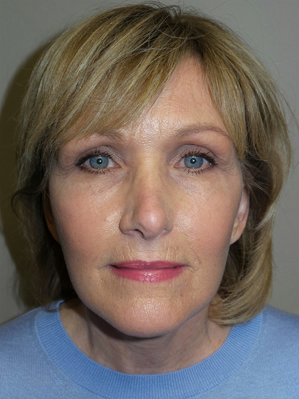 Facelift Before and After 12 | Sanjay Grover MD FACS