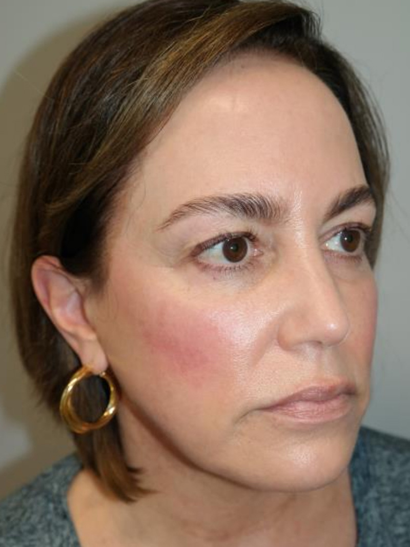Facelift Before and After 21 | Sanjay Grover MD FACS