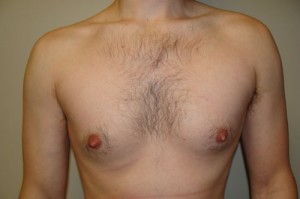 Nipple Reduction Before and After 04 | Sanjay Grover MD FACS