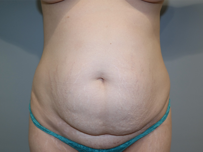 Tummy Tuck Before and After 111 | Sanjay Grover MD FACS