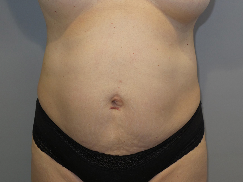 Tummy Tuck Before and After 41 | Sanjay Grover MD FACS