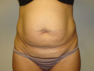 Tummy Tuck Before and After 34 | Sanjay Grover MD FACS