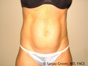 Tummy Tuck Before and After 01 | Sanjay Grover MD FACS