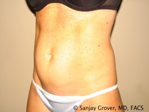 Tummy Tuck Before and After 35 | Sanjay Grover MD FACS