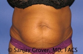 Tummy Tuck Before and After 11 | Sanjay Grover MD FACS