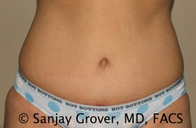 Tummy Tuck Before and After 51 | Sanjay Grover MD FACS