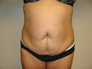 Tummy Tuck Before and After 113 | Sanjay Grover MD FACS