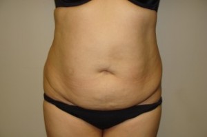 Tummy Tuck Before and After 71 | Sanjay Grover MD FACS