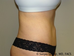 Tummy Tuck Before and After 45 | Sanjay Grover MD FACS