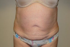 Tummy Tuck Before and After 49 | Sanjay Grover MD FACS
