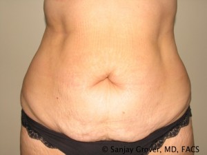 Tummy Tuck Before and After 27 | Sanjay Grover MD FACS