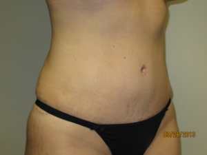 Tummy Tuck Before and After 93 | Sanjay Grover MD FACS