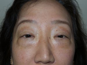Blepharoplasty Before and After 13 | Sanjay Grover MD FACS