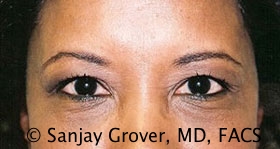 Blepharoplasty Before and After 31 | Sanjay Grover MD FACS