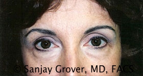 Blepharoplasty Before and After 07 | Sanjay Grover MD FACS