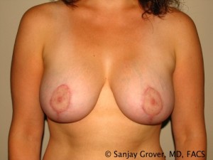 Breast Lift Before and After 15 | Sanjay Grover MD FACS