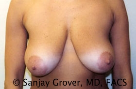 Breast Lift Before and After 04 | Sanjay Grover MD FACS