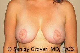 Breast Lift Before and After 24 | Sanjay Grover MD FACS