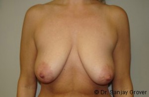 Breast Lift Before and After 33 | Sanjay Grover MD FACS