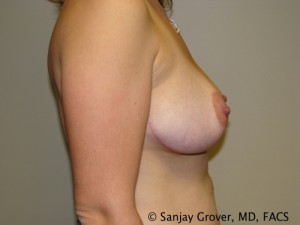 Breast Lift Before and After 29 | Sanjay Grover MD FACS