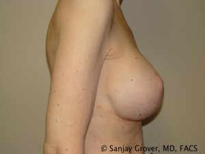 Breast Lift Before and After 30 | Sanjay Grover MD FACS