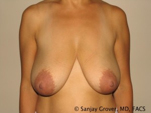 Breast Reduction Before and After 16 | Sanjay Grover MD FACS