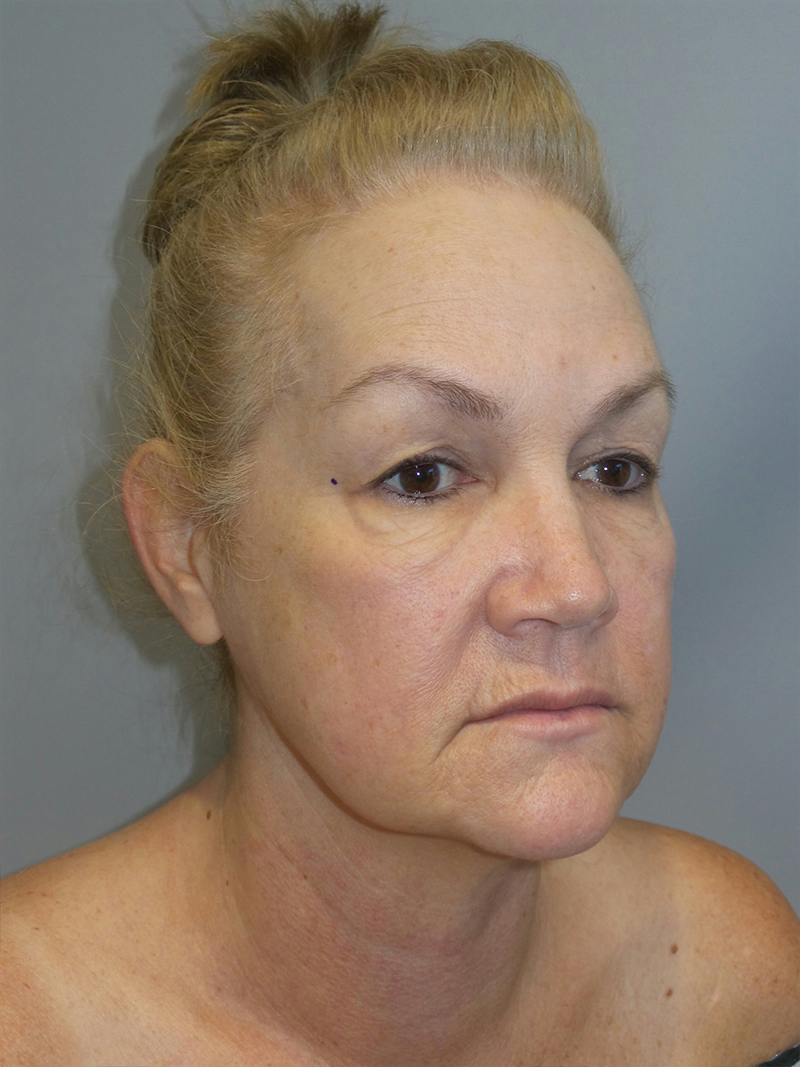 Facelift Before and After 37 | Sanjay Grover MD FACS