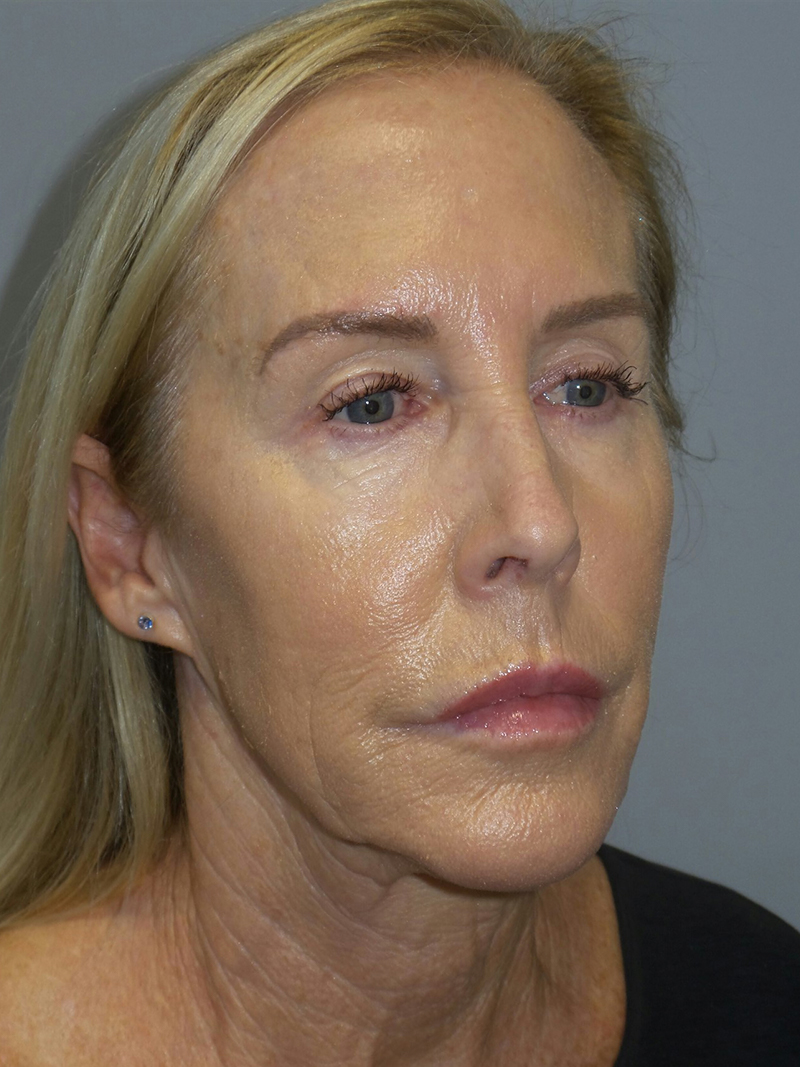 Facelift Before and After 21 | Sanjay Grover MD FACS