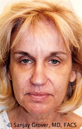 Facelift Before and After 24 | Sanjay Grover MD FACS