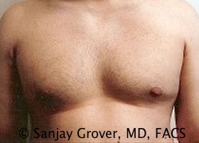 Gynecomastia Before and After 20 | Sanjay Grover MD FACS