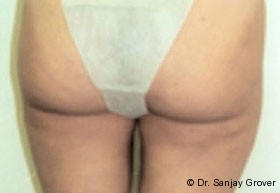 Liposuction Before and After 19 | Sanjay Grover MD FACS