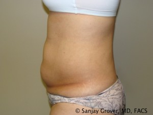 Liposuction Before and After 23 | Sanjay Grover MD FACS