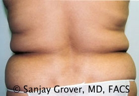 Liposuction Before and After 23 | Sanjay Grover MD FACS