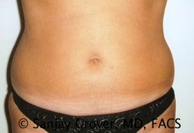 Liposuction Before and After 05 | Sanjay Grover MD FACS