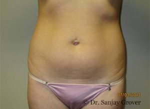 Liposuction Before and After 50 | Sanjay Grover MD FACS