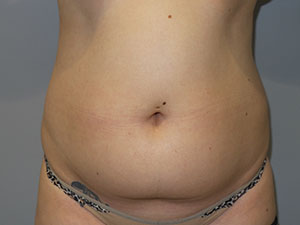 Liposuction Before and After 39 | Sanjay Grover MD FACS