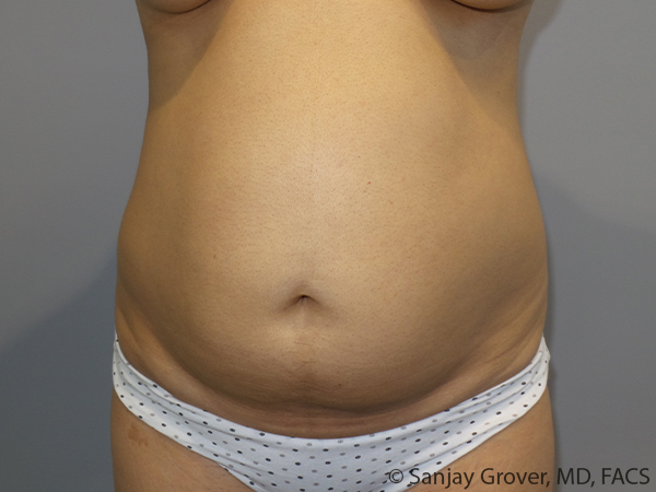 Tummy Tuck Before and After 117 | Sanjay Grover MD FACS