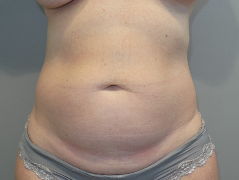 Tummy Tuck Before and After 26 | Sanjay Grover MD FACS