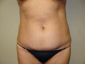 Tummy Tuck Before and After 40 | Sanjay Grover MD FACS