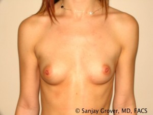 Breast Augmentation Before and After 308 | Sanjay Grover MD FACS