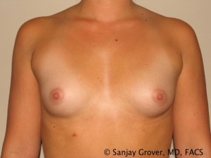 Breast Augmentation Before and After 92 | Sanjay Grover MD FACS