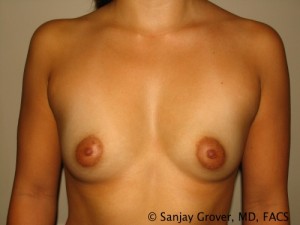 Breast Augmentation Before and After 268 | Sanjay Grover MD FACS