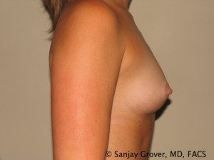 Breast Augmentation Before and After 113 | Sanjay Grover MD FACS