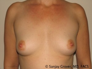Breast Augmentation Before and After 61 | Sanjay Grover MD FACS