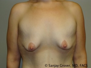 Breast Augmentation Before and After 79 | Sanjay Grover MD FACS