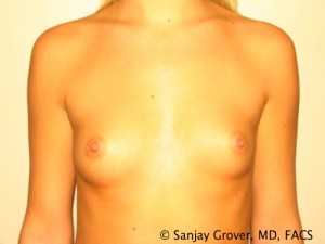 Breast Augmentation Before and After 109 | Sanjay Grover MD FACS