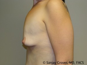 Breast Augmentation Before and After 126 | Sanjay Grover MD FACS