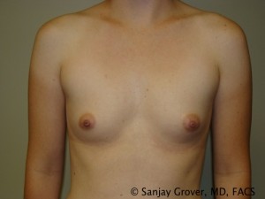 Breast Augmentation Before and After 62 | Sanjay Grover MD FACS